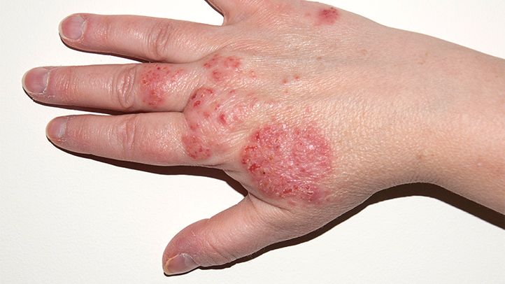 Eczema on Hand - Treatment in Kerala, Maurya ayurveda