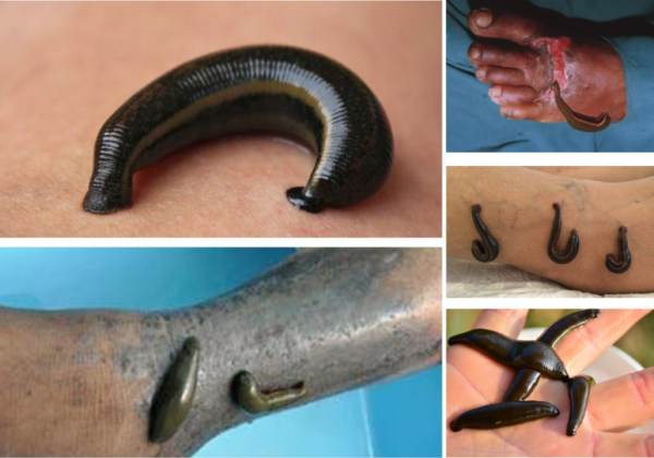 Showing leech therapy or blood letting at maurya ayurveda