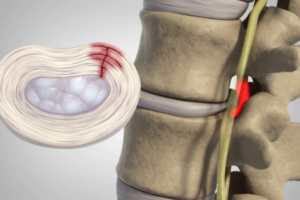 intervertebral disc prolapse