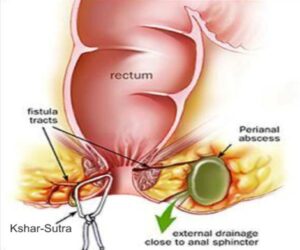 kshara sutra- Anal fistula