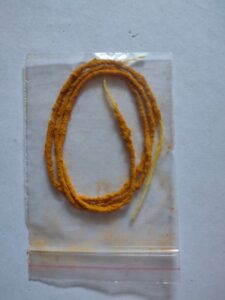 kshara sutra thread-anal fissure