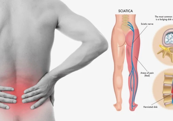SCIATICA