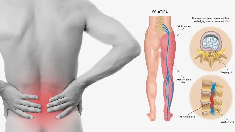 SCIATICA