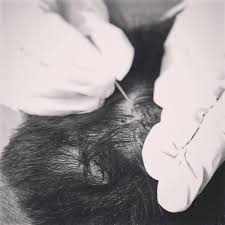 Prachchanna-Hair fall