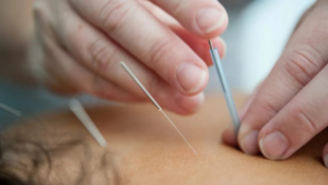 Needling-Acupuncture
