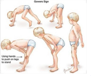 GOWERS SIGN-MUSCULAR DYSTROPHY