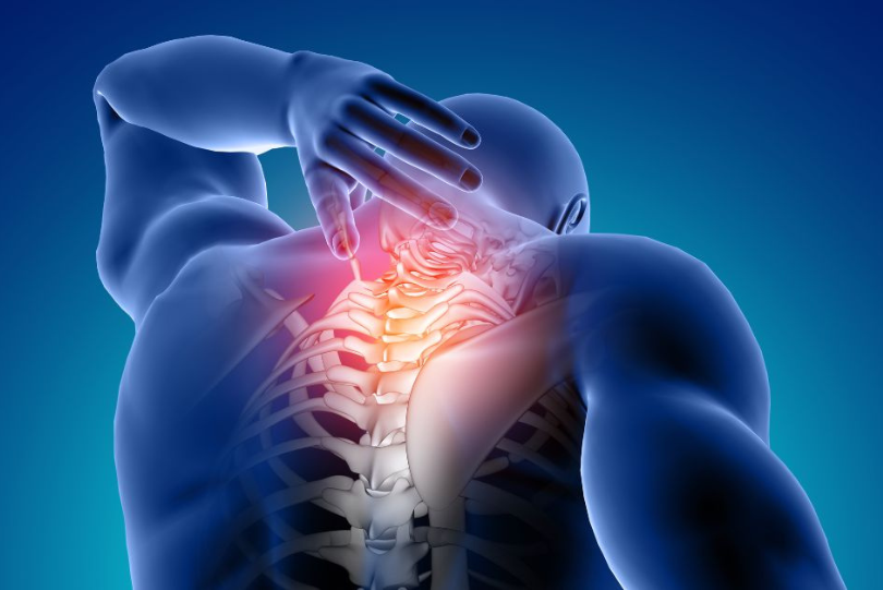 SYRINGOMYELIA