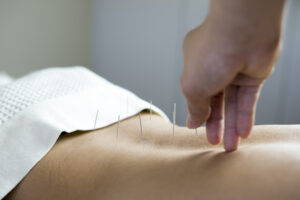 PIRIFORMIS SYNDROME-ACUPNCTURE