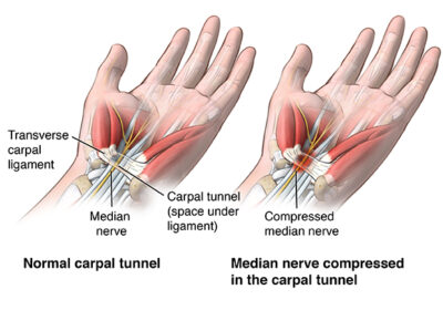 CARPAL TUNNEL SYNDROME