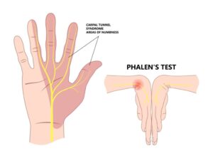 Phalen's test for CTS
